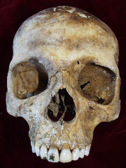 Inlays on the right upper incisors