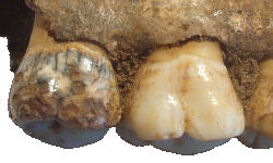 Enamel hypoplasia