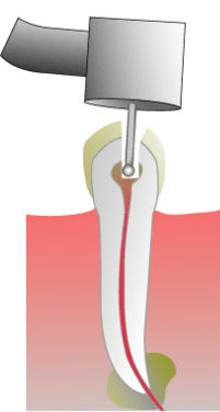 Root Canal procedure: unhealthy tooth, drilling, filing, rubber filling.