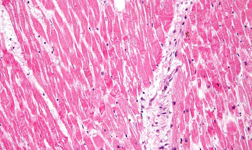 acute myocardial infarction