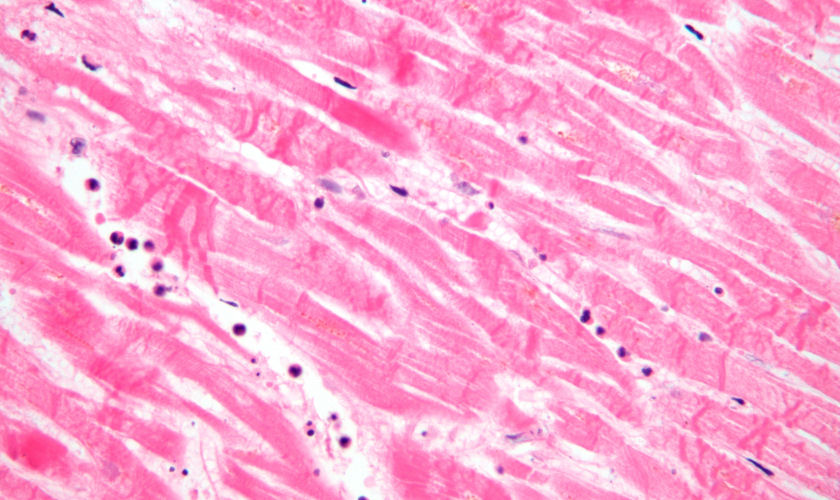 acute myocardial infarction