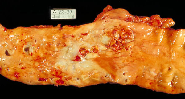 atherosclerosis