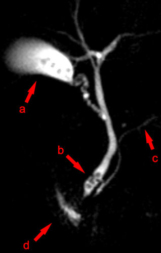 Magnetic resonance cholangiopancreatography