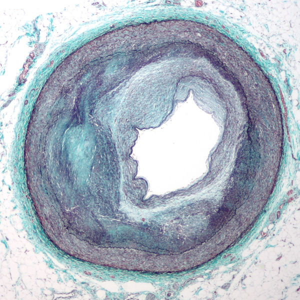 distal right coronary artery with complex atherosclerosis